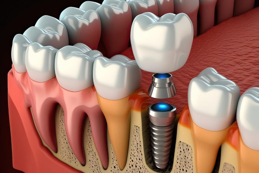 tooth loss and dental implants