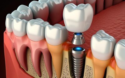 Tooth Loss And Dental Implants