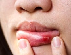 What Are Canker Sores