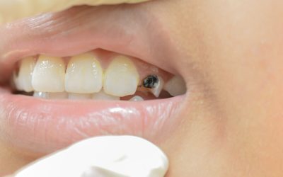 Cavities Prevention: How You Can Fight Cavities Away