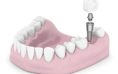 Top 5 Dental Implants Myths and Facts