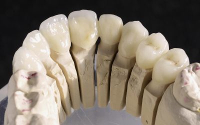 What are the Top Three Benefits of Dental Crowns?