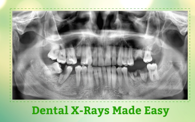 Modern Dental X-rays Made Easy