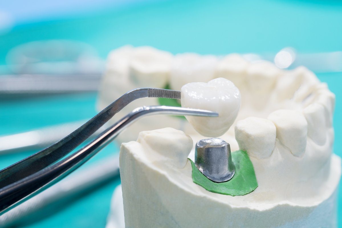 Dentist Main Beach Tips Top 5 Benefits of Crowns and Bridges