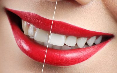 Whiten your Teeth at Main Beach Dental
