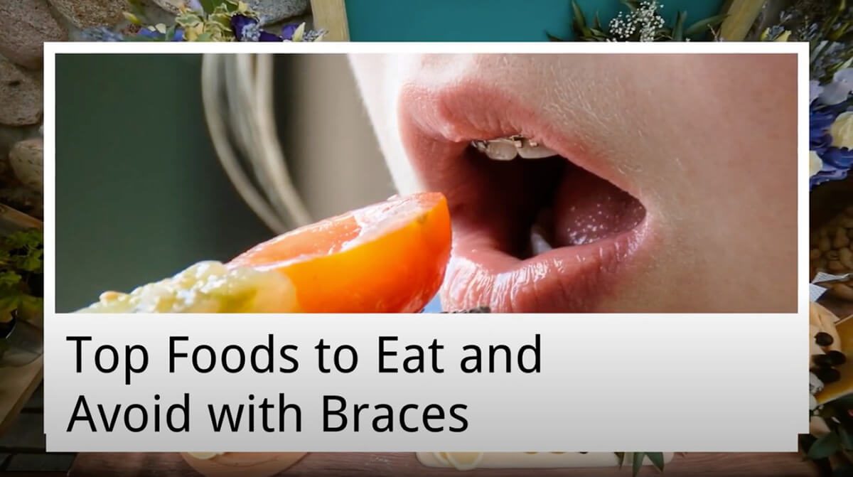 top foods to eat and avoid with braces from main beach dental